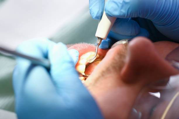 Best Emergency Wisdom Tooth Extraction in Caldwell, NJ
